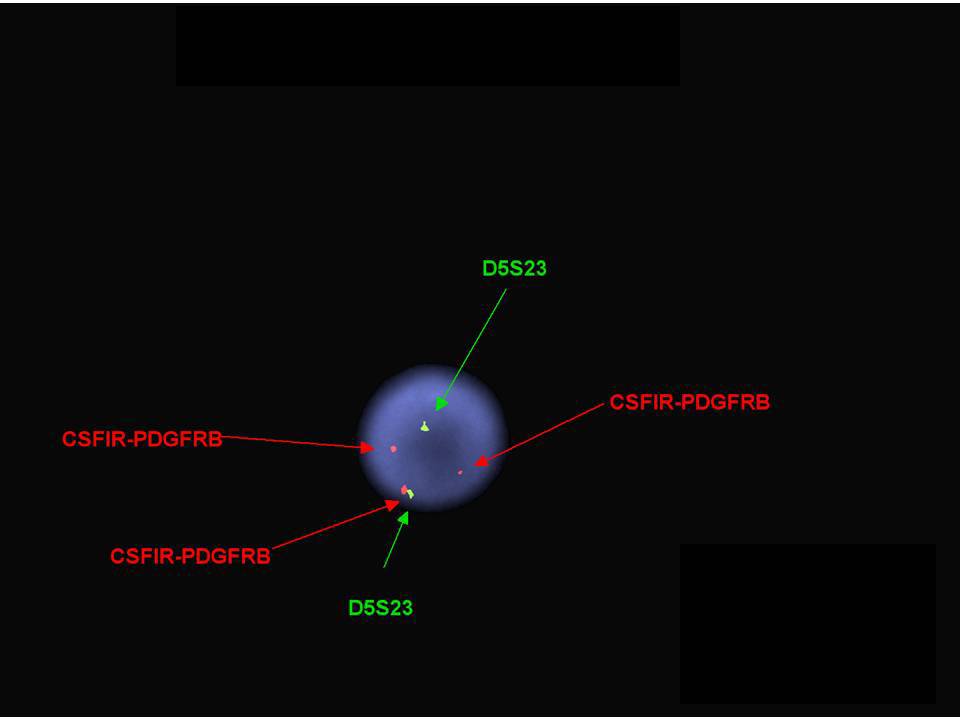 Fluorescent in situ hybridization of BM3 demonstrating PDGFRB translocation.